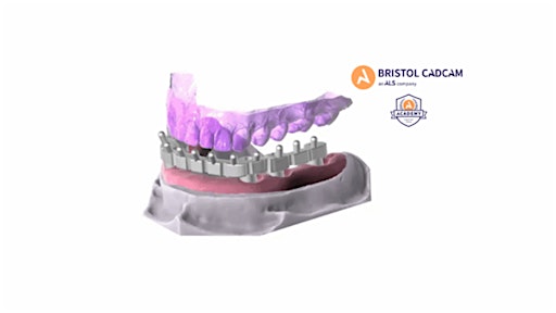 Exocad Advanced- Full Arch Bar Design