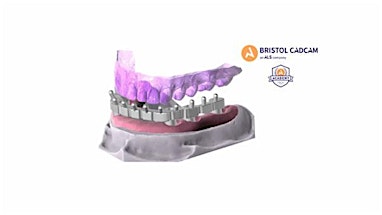 Exocad Basic Crown and Bridge