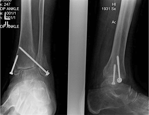 CURRENT CONTROVERSIES IN ANKLE FRACTURE MANAGEMENT