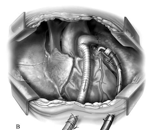 Advanced Heart Failure Symposium - MCS