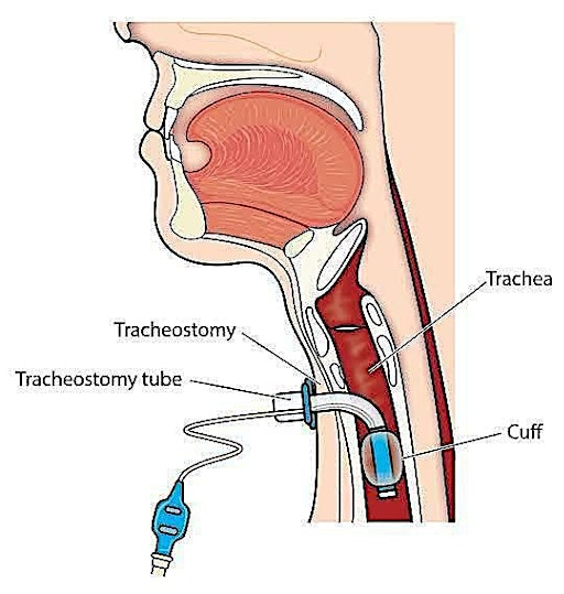 Trache CEN study day 2026: Tracheostomy Across Pathways