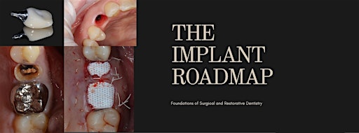 The Implant Roadmap 101