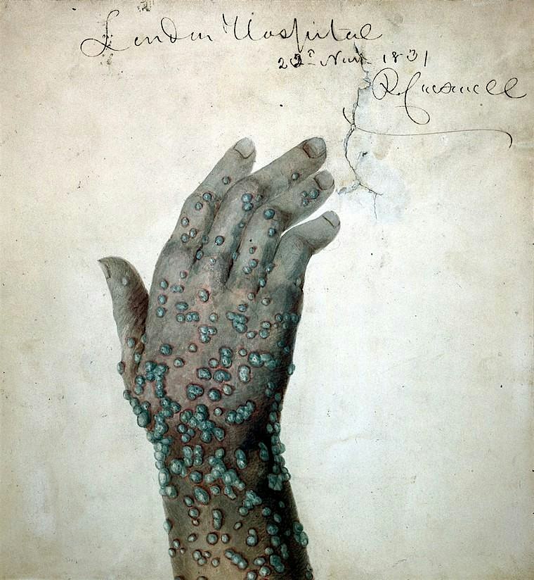 Smallpox in Early Boston: A free walking tour!