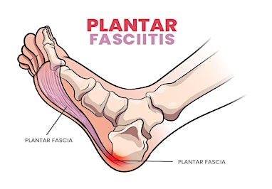 Plantar Fasciitis Workshop