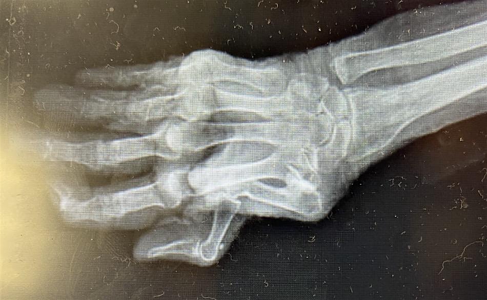 Pain Science in Hand Therapy: Modern strategies for Clinical Practice